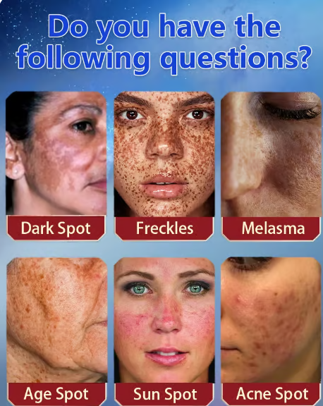 🔥Vitamin C Whitening Freckles Face Cream Remove Melasma Dark Spots Lighten Melanin