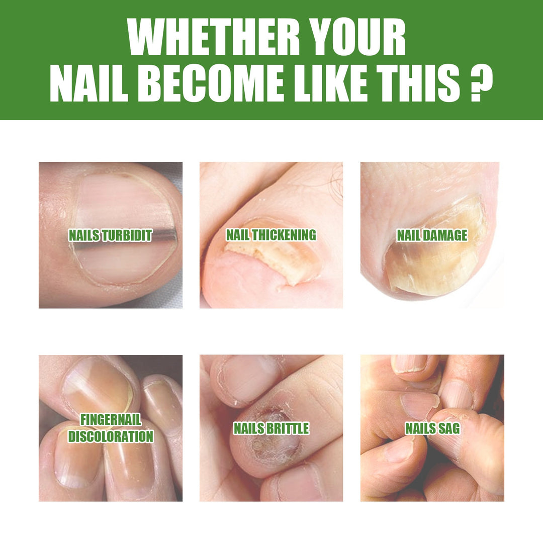 (Anti Fungal Stick) Say Goodbye to Nail Fungus in Just 5 Days!