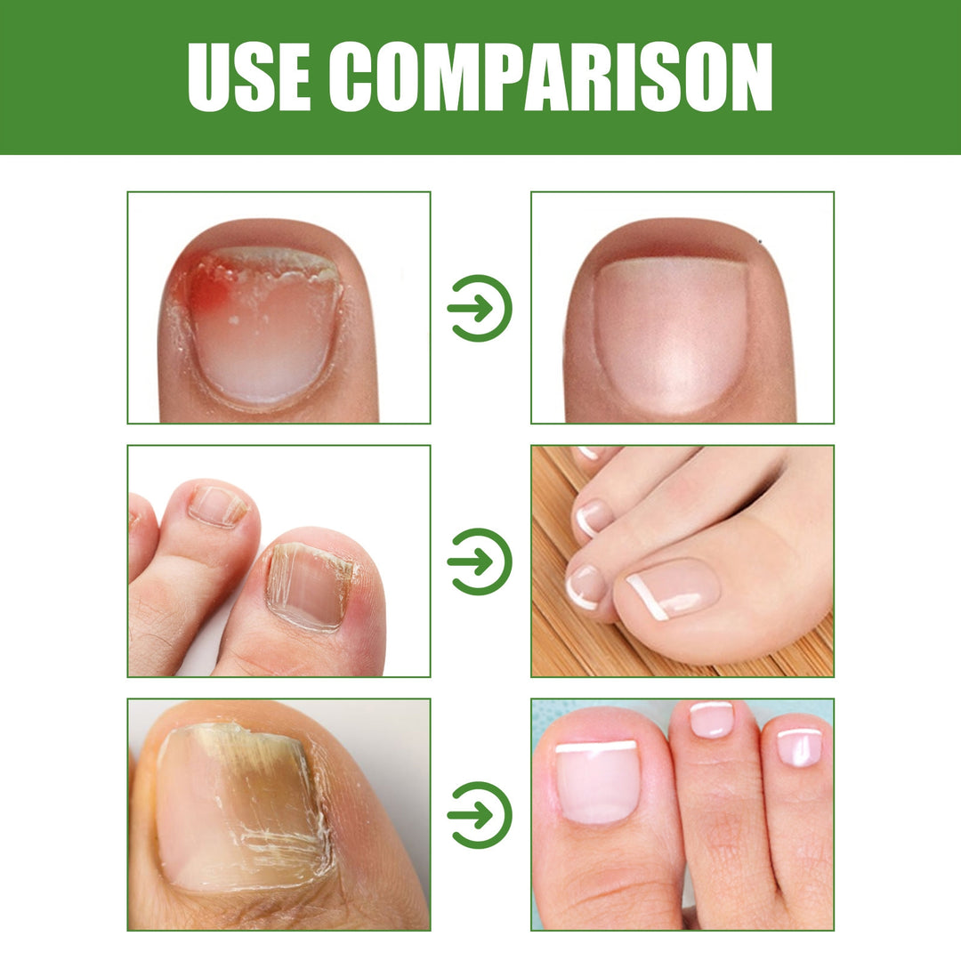 (Anti Fungal Stick) Say Goodbye to Nail Fungus in Just 5 Days!