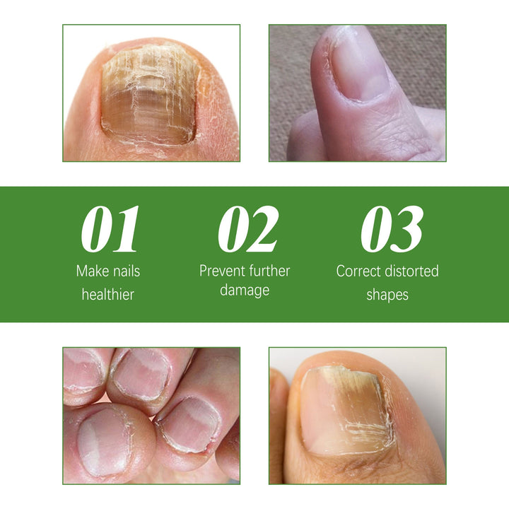 (Anti Fungal Stick) Say Goodbye to Nail Fungus in Just 5 Days!