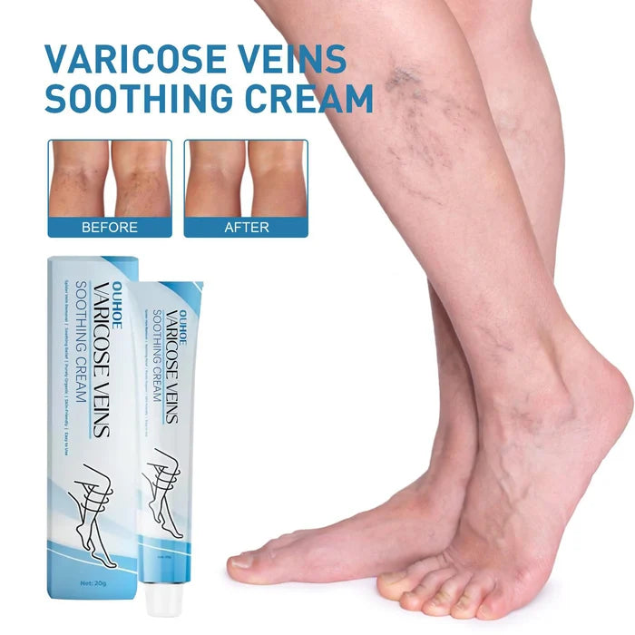 💥2024 Experts Recommend Product-Varicose Veins Treatment Cream