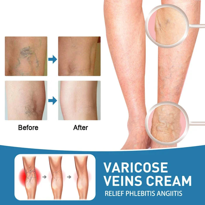 💥2024 Experts Recommend Product-Varicose Veins Treatment Cream