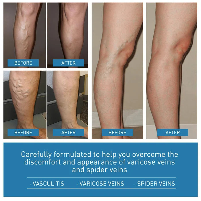 💥2024 Experts Recommend Product-Varicose Veins Treatment Cream