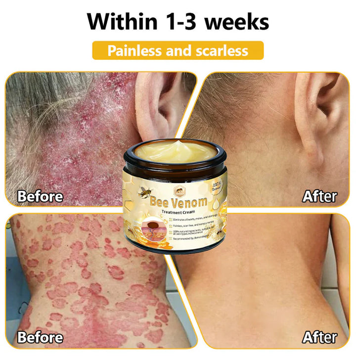 Bee Venom Skin Treatment Cream