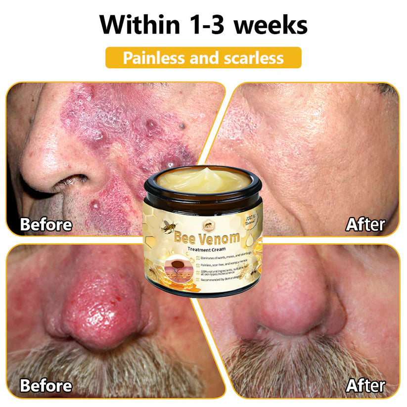 Bee Venom Skin Treatment Cream