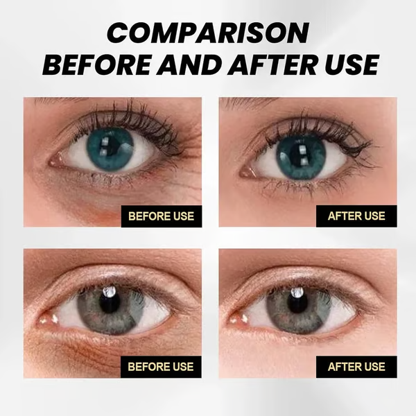 Temporary Eye Tightener
