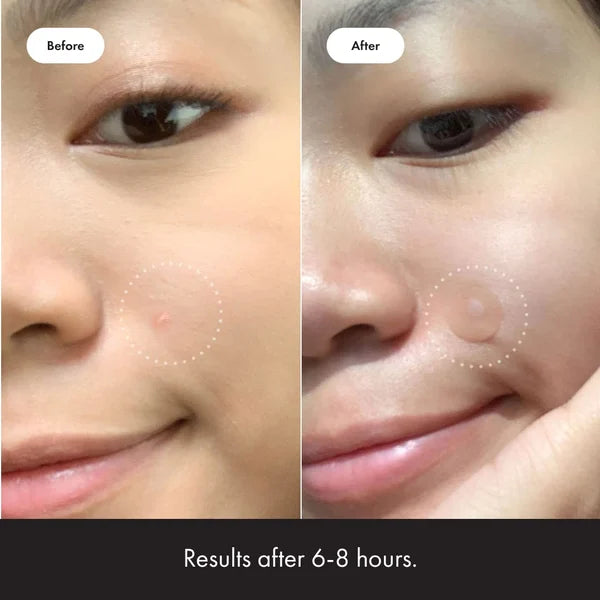 ✨ 2024 Hydrocolloid Acne Cover Patches（🔥Buy 3 Get 3 Free）