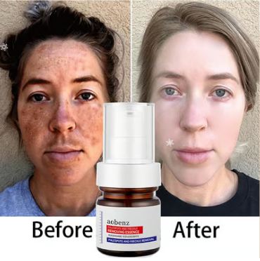 Vitamin C Whitening Freckles Face Cream Remove Melasma Dark Spots Lighten Melanin