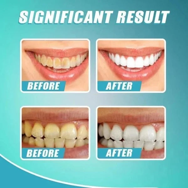 Last Day Promotion 48% OFF - Intensive Stain Removal Whitening Toothpaste