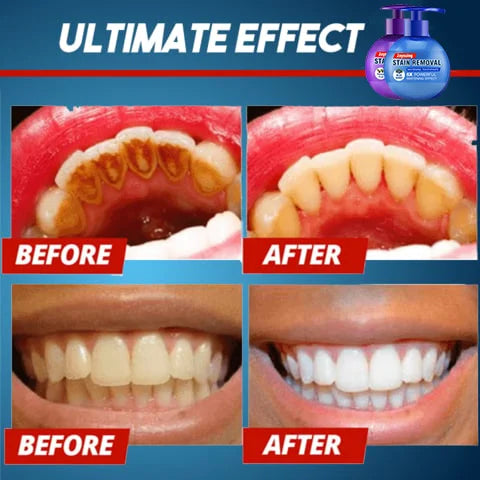 Last Day Promotion 48% OFF - Intensive Stain Removal Whitening Toothpaste