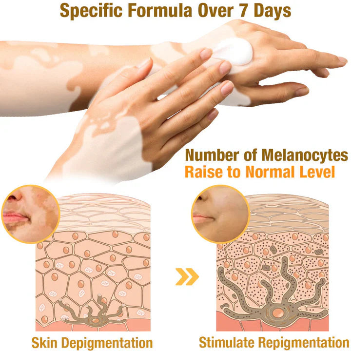 BeeVenom Vitiligo Treatment Cream