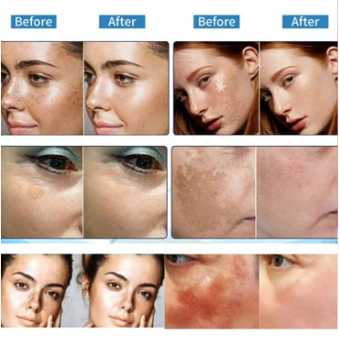 Vitamin C Whitening Freckles Face Cream Remove Melasma Dark Spots Lighten Melanin