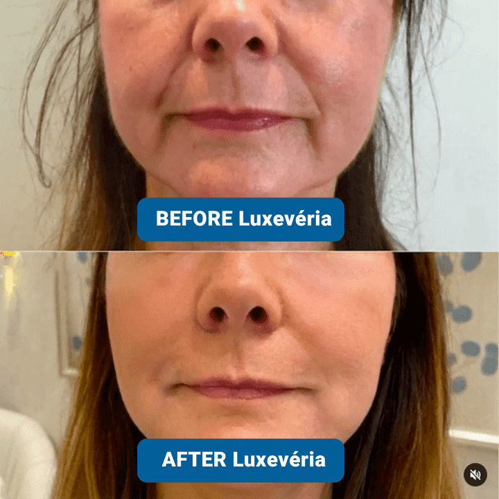 ✨ Last Day Buy 1 Get 1 Free ✨3% Hyaluronic Acid Ultra Hydrating Serum by Luxevéria
