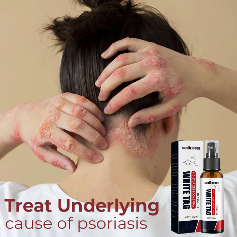 🔥PSORIASIS RELIEF SPRAY🔥