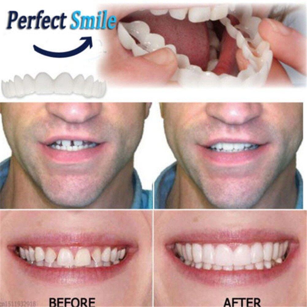 Adjustable Snap On Dentures