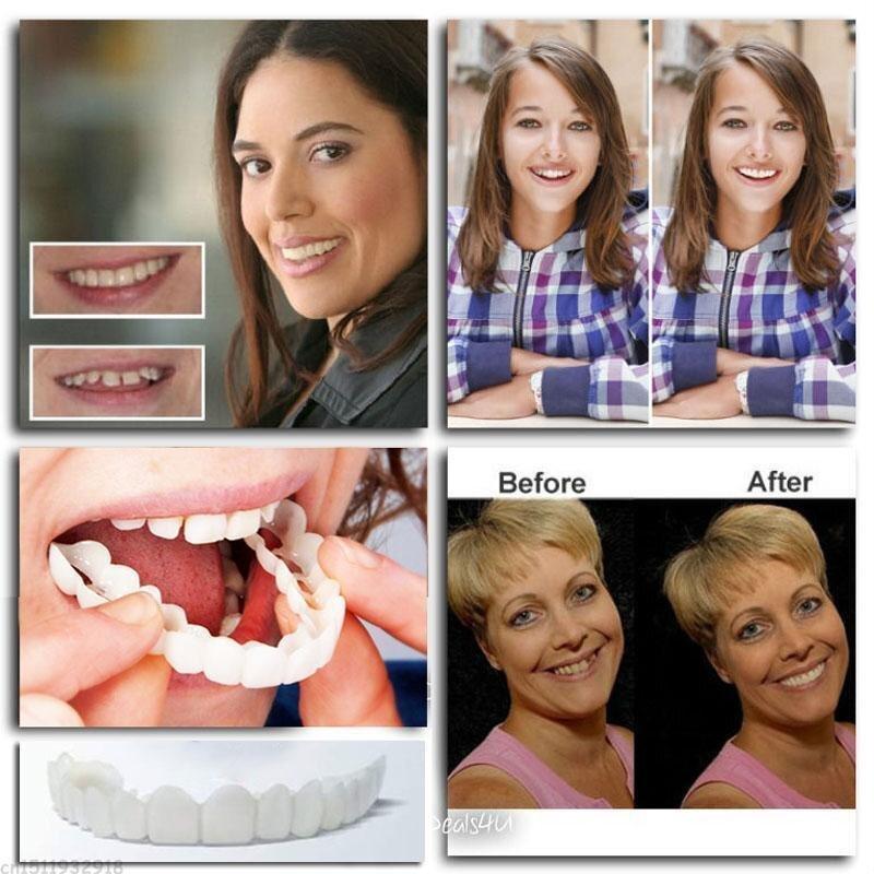Adjustable Snap On Dentures