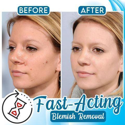 WartsOff Instant Blemish Removal Cream