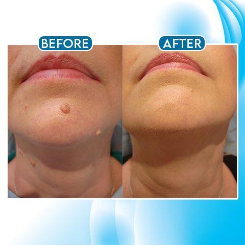 WartsOff Instant Blemish Removal Cream