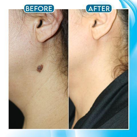 WartsOff Instant Blemish Removal Cream